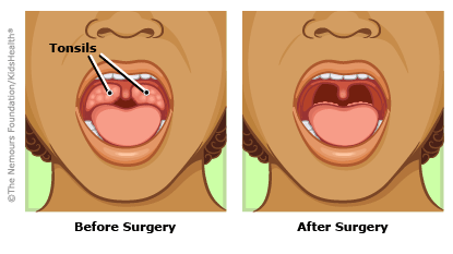 tonsilectomy-415x233-rd4-enIL.png
