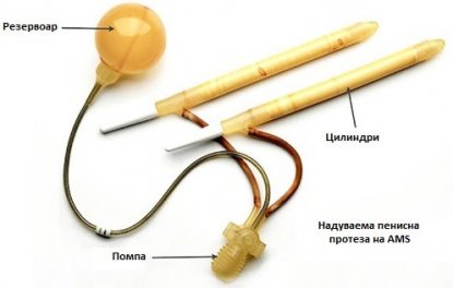 AMS-penile-implant.jpg